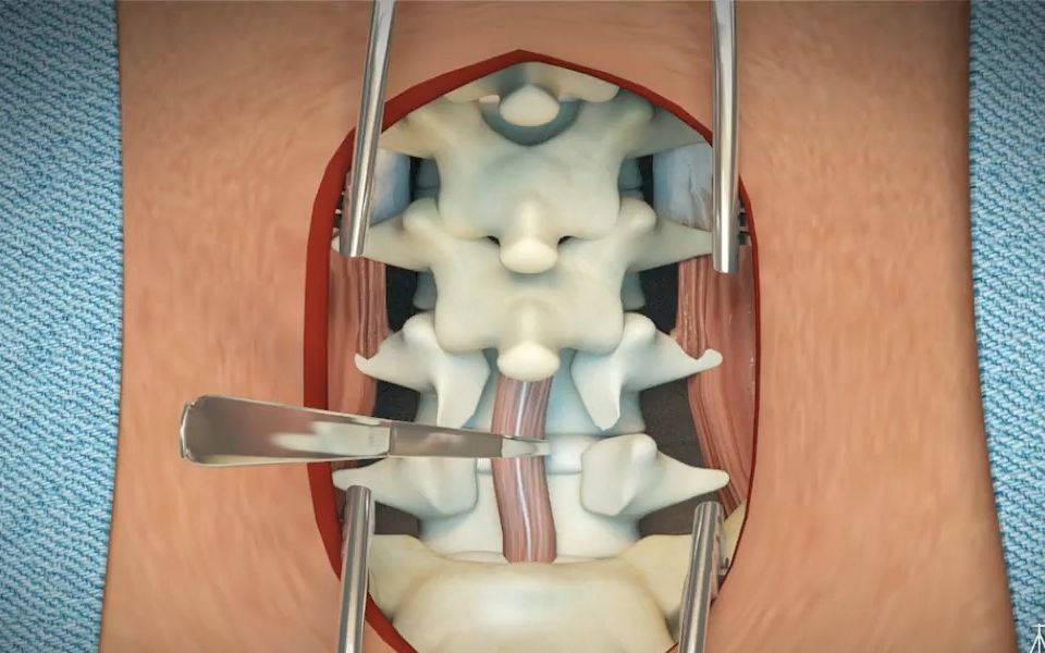 腰间盘手术视频直播，现代医疗技术的透明化及普及展现