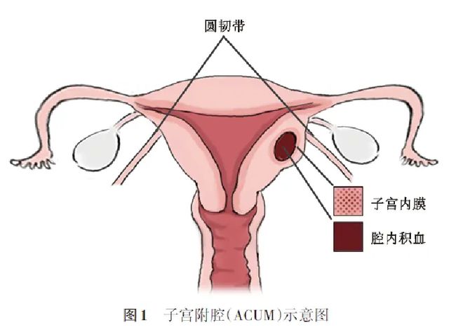 慢性盆腔痛最新疗法研究与应用